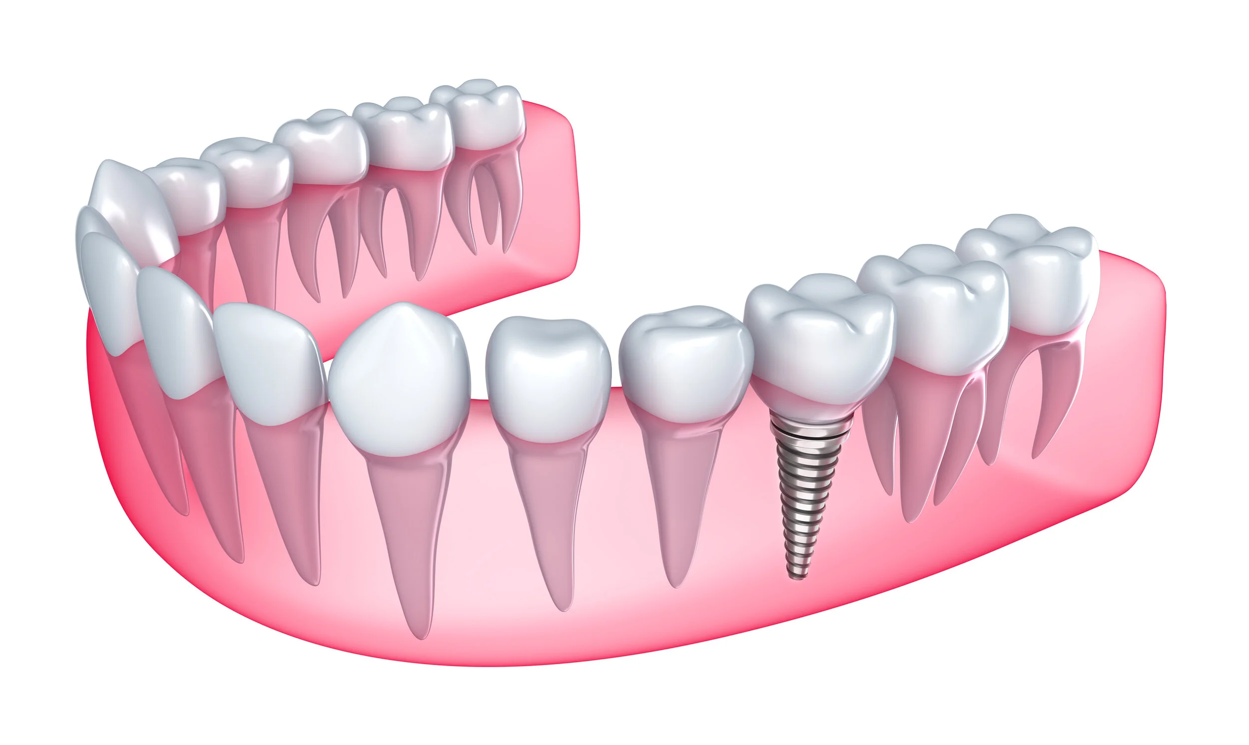 Single-Tooth | Dentures for Single Tooth Replacement – IDCFD