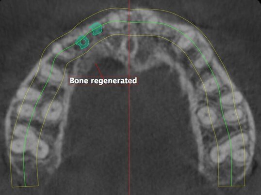 AFTER: CBCT SCAN
