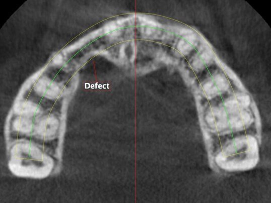 BEFORE: CBCT SCAN