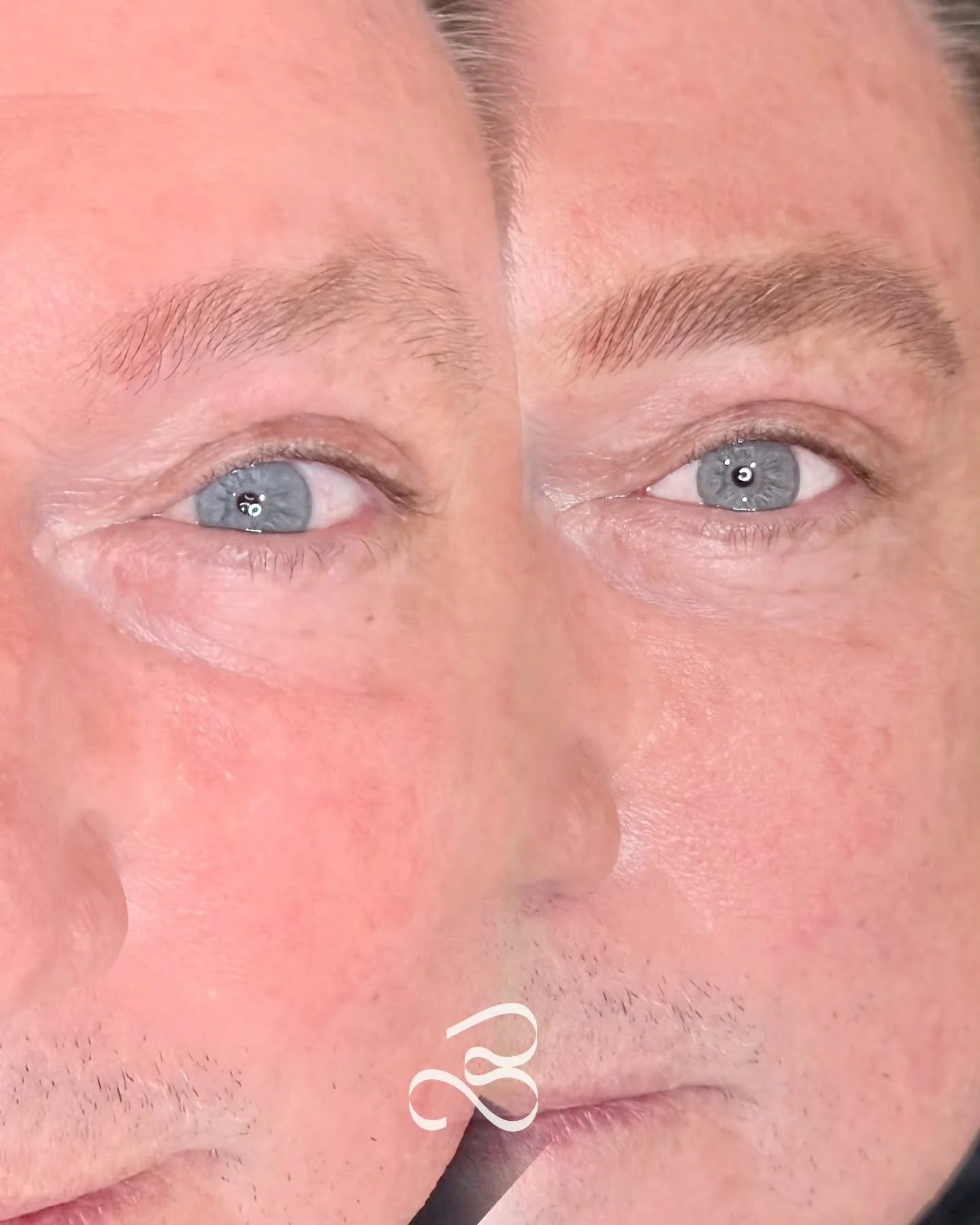 This gentleman wanted to restore what time had gradually taken away &mdash; creating the appearance of fuller, more defined brows while keeping everything soft, natural and age-appropriate.

Using our Nano Brow technique, we were able to mimic real h