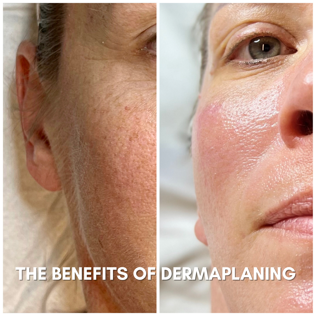 Here is a before and after picture of a demaplane client who is now peach fuzz free