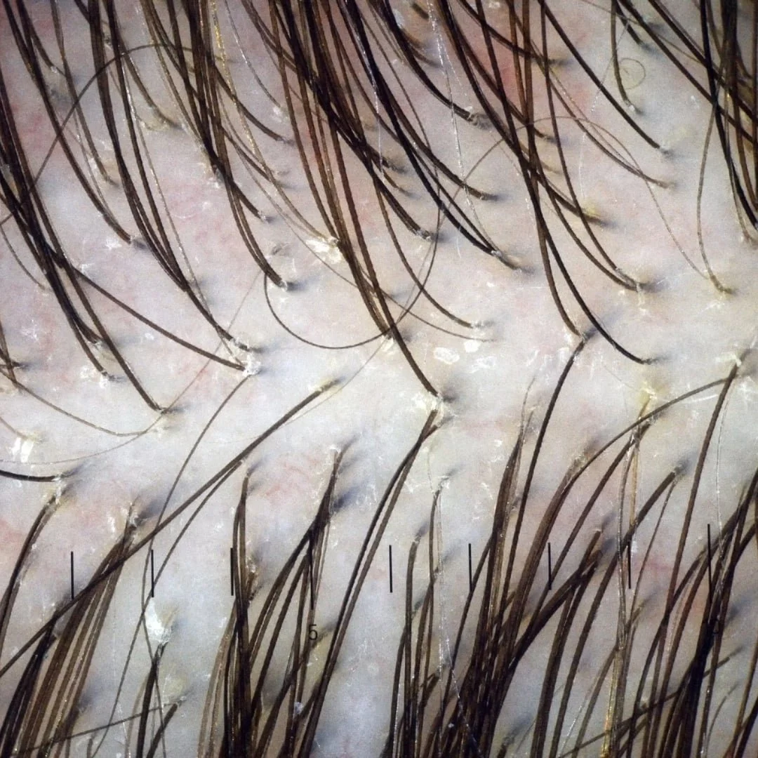 Here is an image using a scope to show scalp health before your treatment to diagnose hair follicle problems