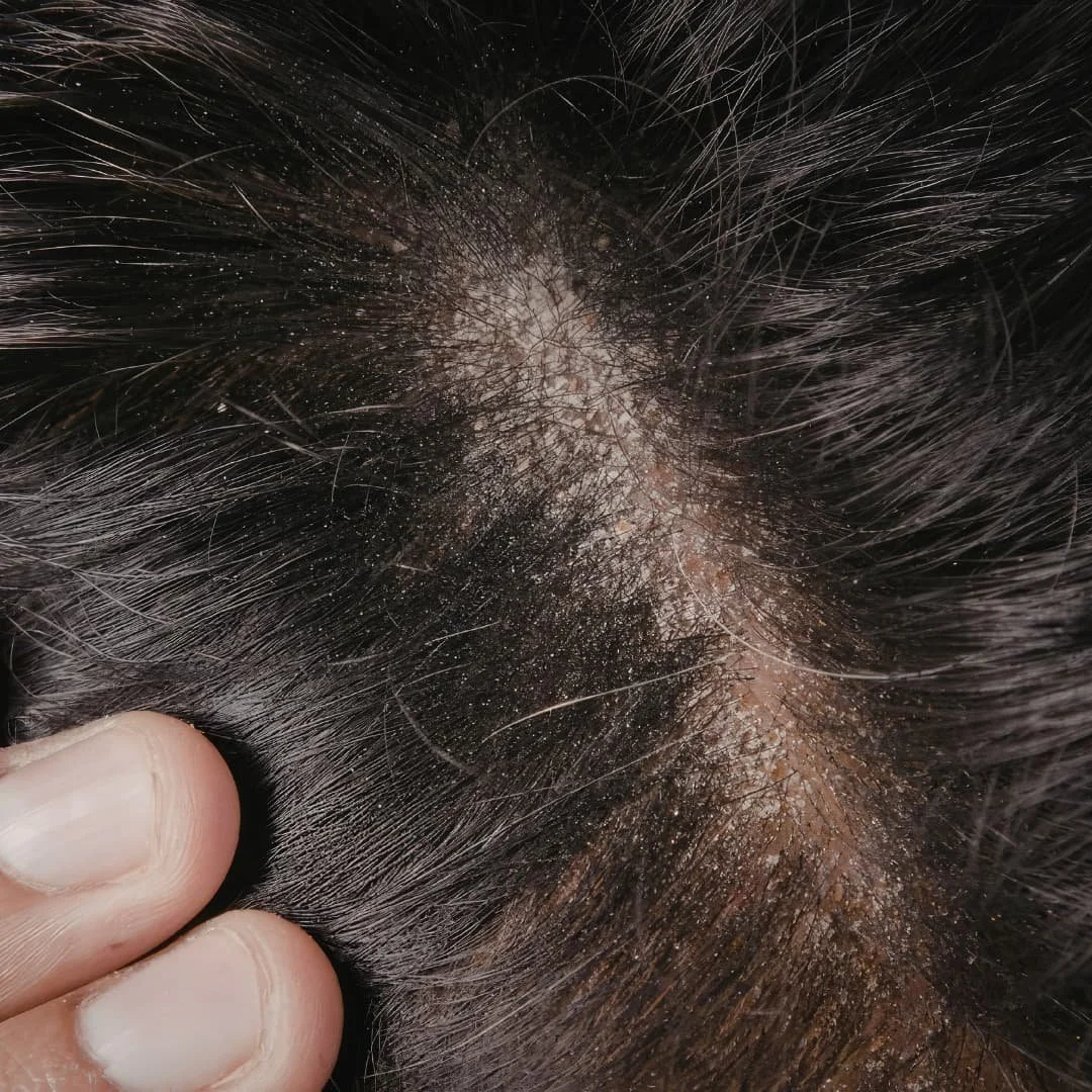 Here is an image of a client with bad scalp health and weighed down hair and scalp that has become clogged with oil and debris