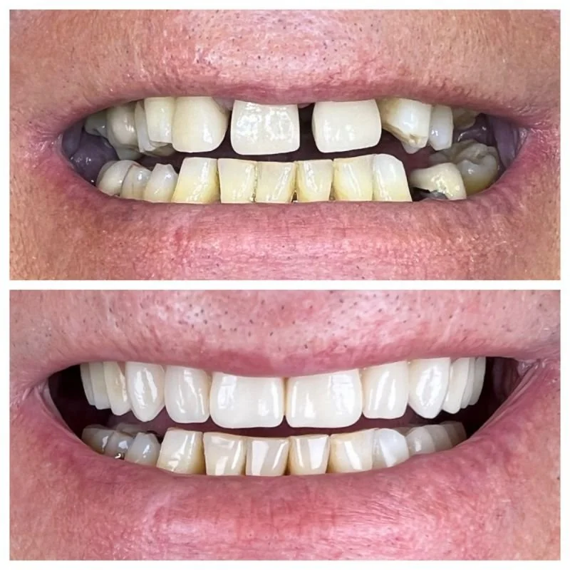 Denture Clinic Sunshine Coast All Smiles Denture Clinic