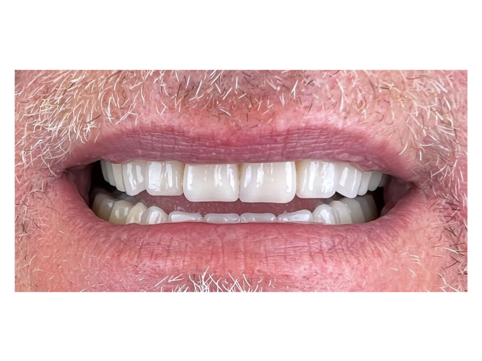 how-much-does-a-denture-reline-cost-in-australia-all-smiles-denture