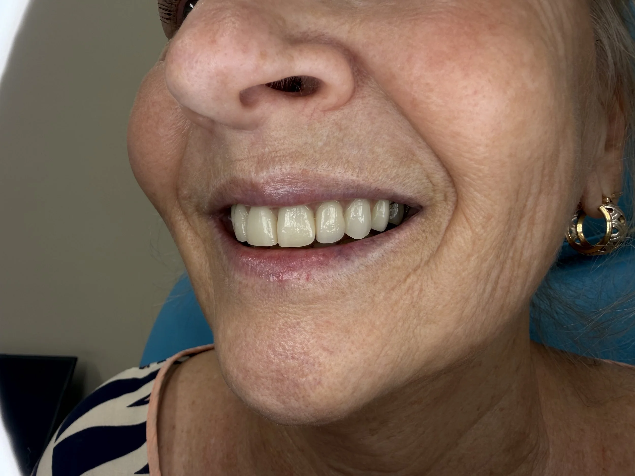 Denture Clinic | Sunshine Coast and Bribie Island