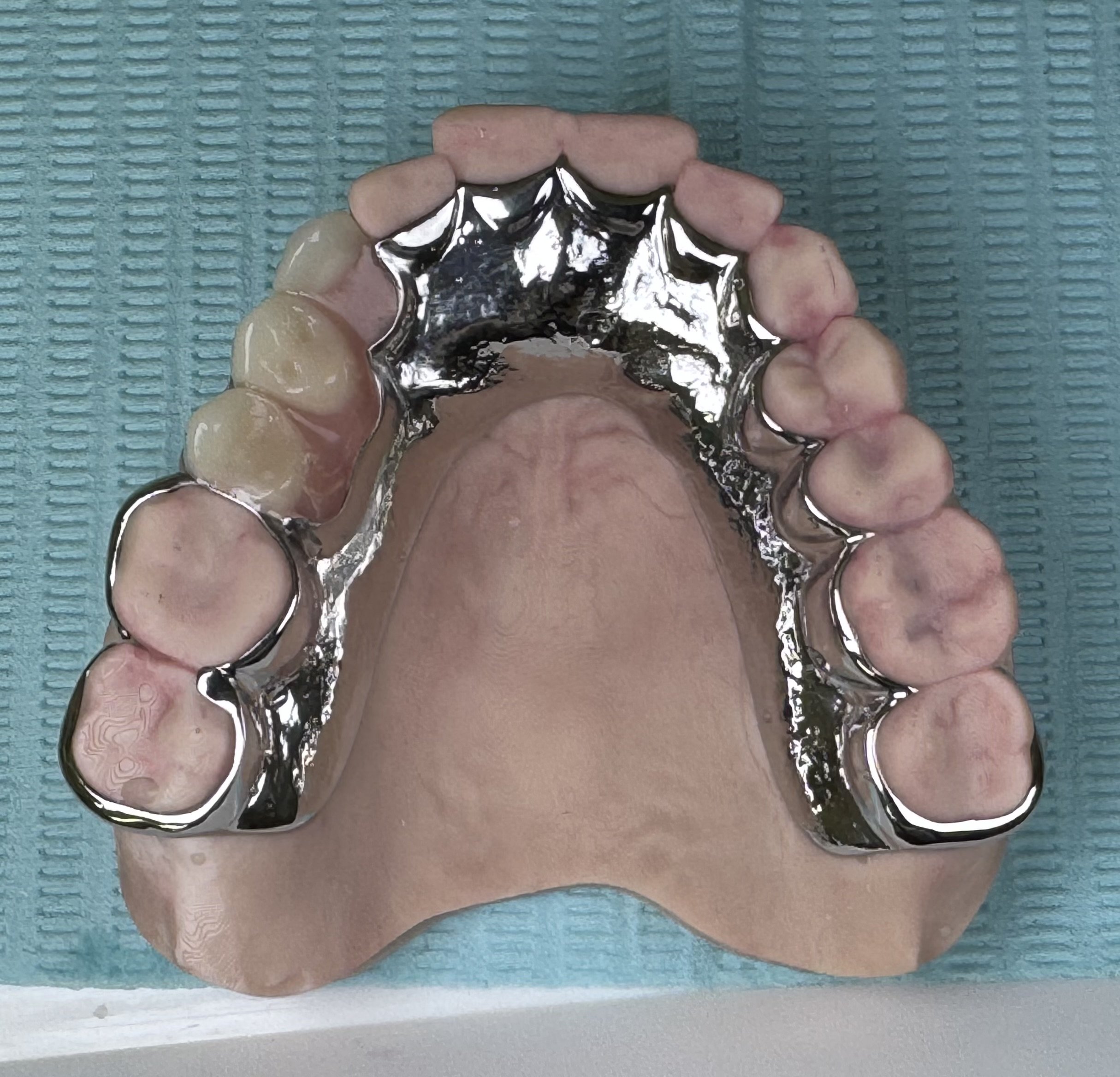 Chrome Metal Partial Dentures | Denture Clinic Sunshine Coast
