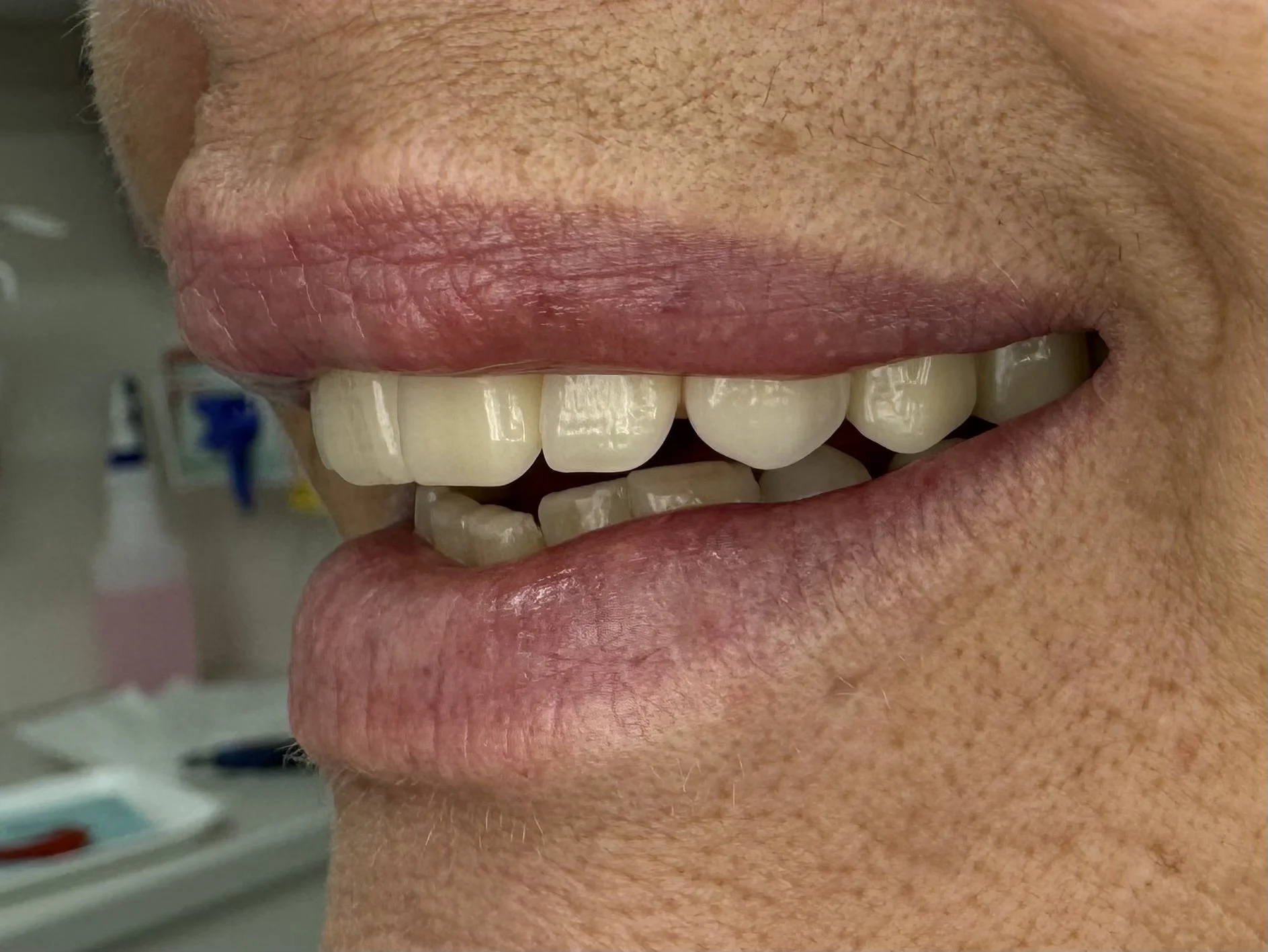 Emergency Denture Repairs, Relines and Additions | Sunshine Coast Denture Clinic