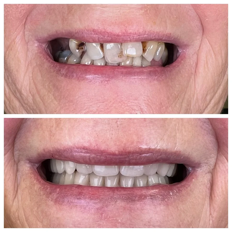 Denture Clinic Sunshine Coast All Smiles Denture Clinic