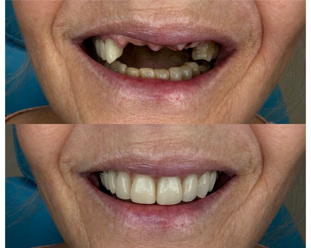 Immediate Dentures Sunshine Coast | All Smiles Denture Clinic