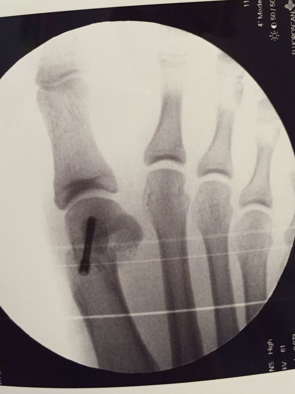 X-Ray of Right Foot Post-Surgery