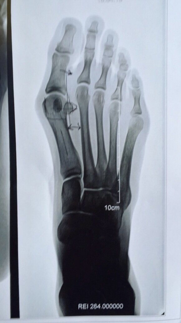 Right Foot Pre-Surgery X-Ray