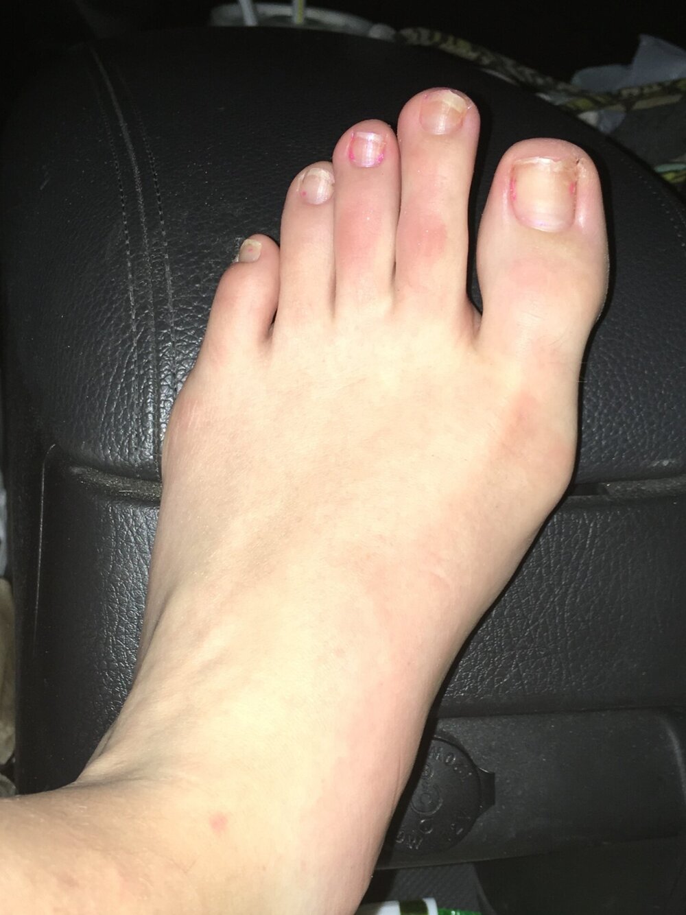 Left Foot Pre-Surgery
