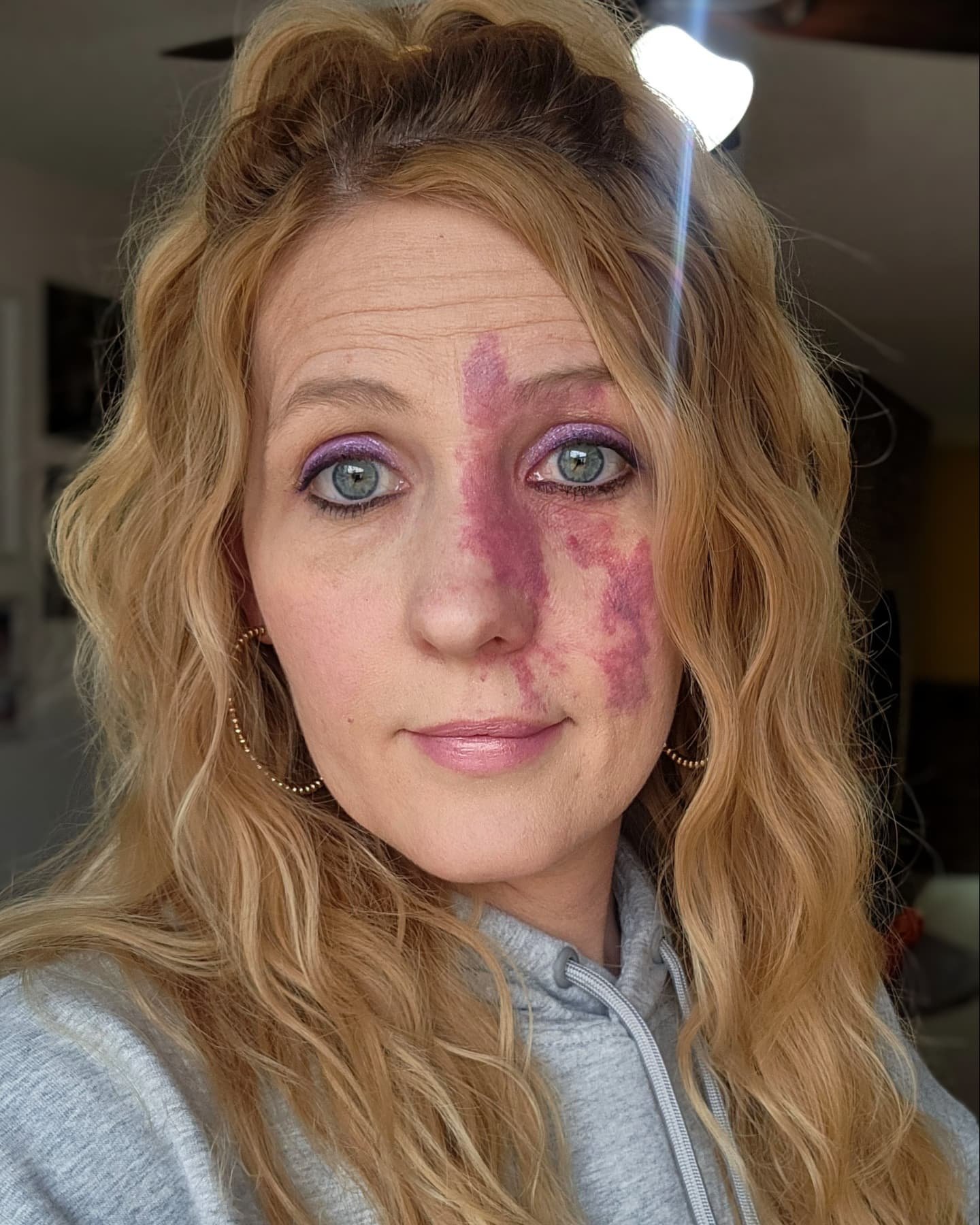 #putonyourbirthmark  It's national birthmark day!

#birthmark #vbirthmarks #vbfmoa2025