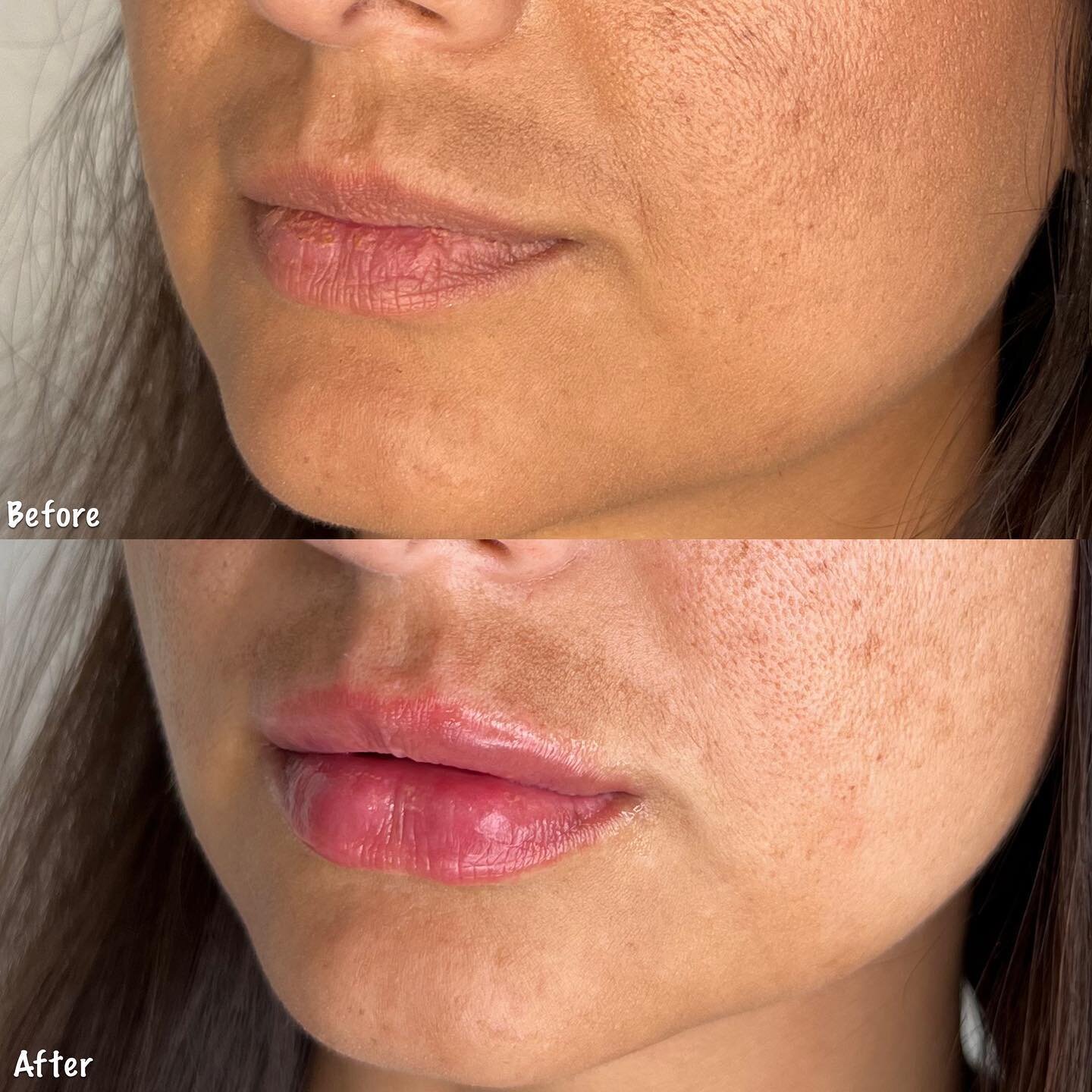 1 cc of lip filler for hydration and filler 💉&hearts;️.

Provider👩🏻&zwj;⚕️: @the_aesthetik_pa 

#vollurelips #vollure #lipfiller #filler #dermalfillers #lips #physicianassociate #costamesa #medspa