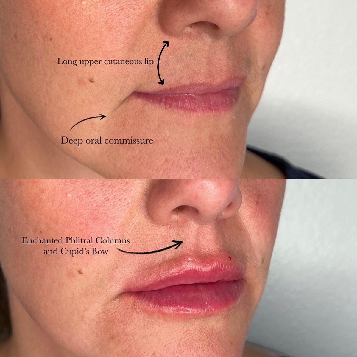 Lip enhancement💋 

Lip filler can do so much more than simply increase lip size and lip projection. Lip filler can also:

✔️Diminish the appearance of deep oral deep commissures (&ldquo;frown&rdquo;)

✔️Enhance philtral columns and Cupid&rsquo;s Bow