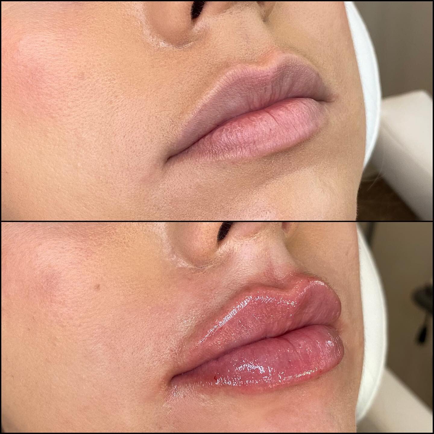 &bull;Lip Augmentation&bull;

&ldquo;Your lips are like your fingerprint&rdquo;💋
Adding volume to this beauty for a second session with one syringe of filler. Keeping it natural while enhancing beauty and confidence. 

Injector: Onil @aesthetika_smp