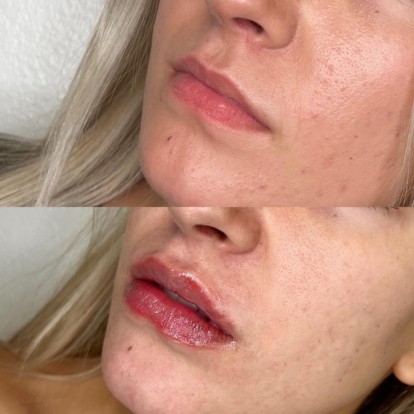 Lips 🙂: 

Our first time lip filler patient was interested in balancing her upper and lower lip. She requested a very subtle and natural enhancement to correct her lip asymmetry.

0.7 cc of Juv&eacute;derm Ultra was used to:
✔️ Increase the size of 