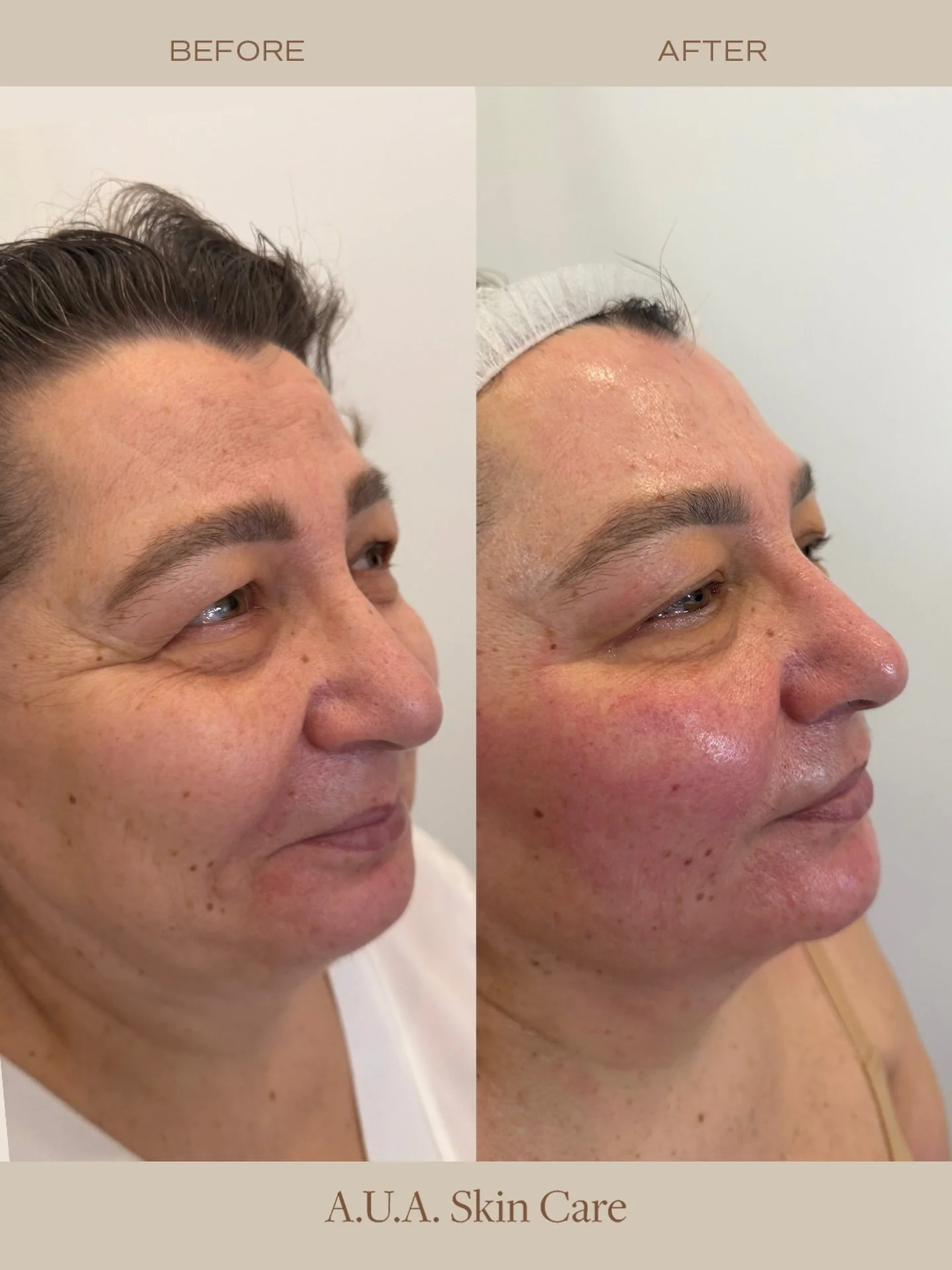 Hello, gorgeous results from HydraFacial&reg; Deluxe ✨

One treatment that leaves your skin deeply cleansed, hydrated, refreshed, and glowing&mdash;without downtime.

Whether you&rsquo;re preparing for a special event or simply giving your skin the c
