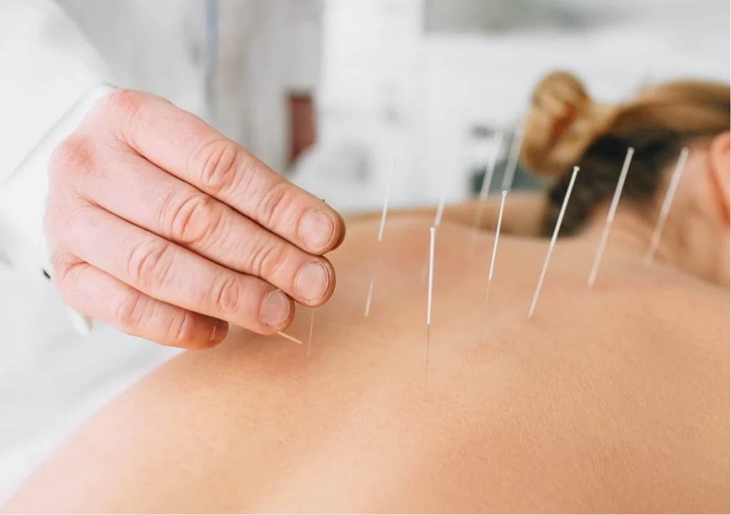 Dry needling physiotherapy treatment Liverpool Western Sydney Vital Action Physio trigger pointperforming hands-on treatment at Vital Action Physio Western Sydney