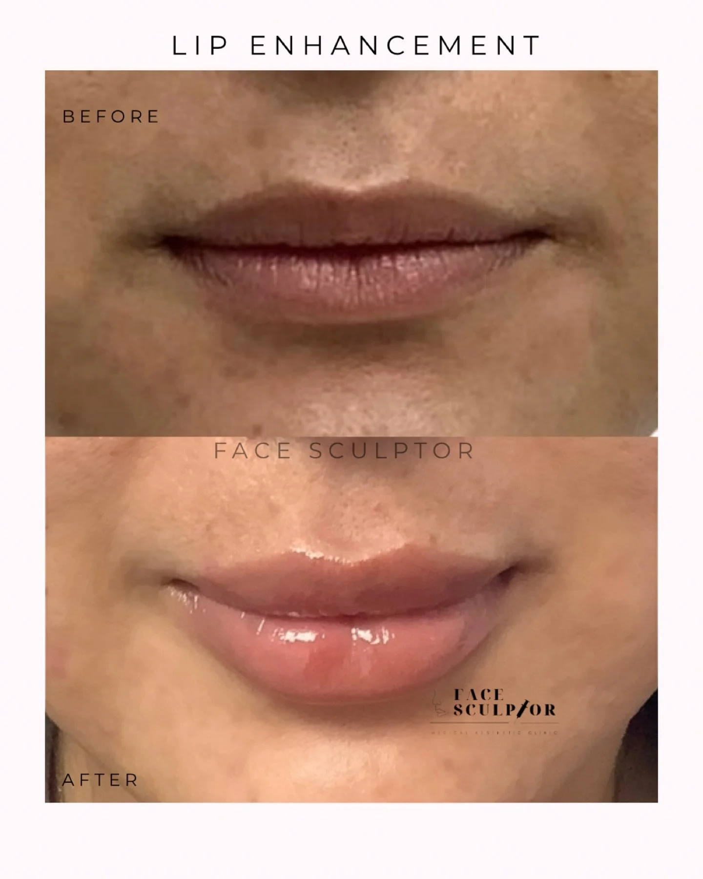 Beautifully enhanced lips: soft, hydrated, natural-looking, and perfectly balanced. 💕 Always aiming for results that complement your unique features.

&bull; 💉 By Nurse Chiara 👄 

---

#LipFiller #DermalFiller #FillerResults #NaturalLips #LipGoals
