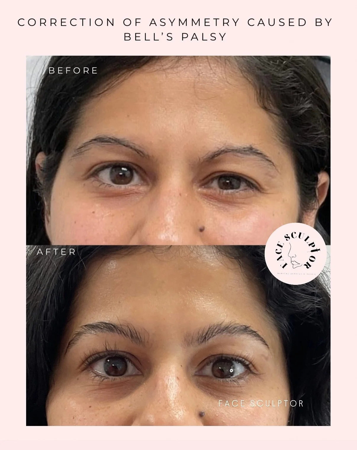 Correcting asymmetry caused by Bell&rsquo;s palsy through precise Botox treatment. 
Anatomy is the foundation of our field. Treatments like this require a highly skilled injector who understands the complex nature of facial anatomy and muscle dynamic