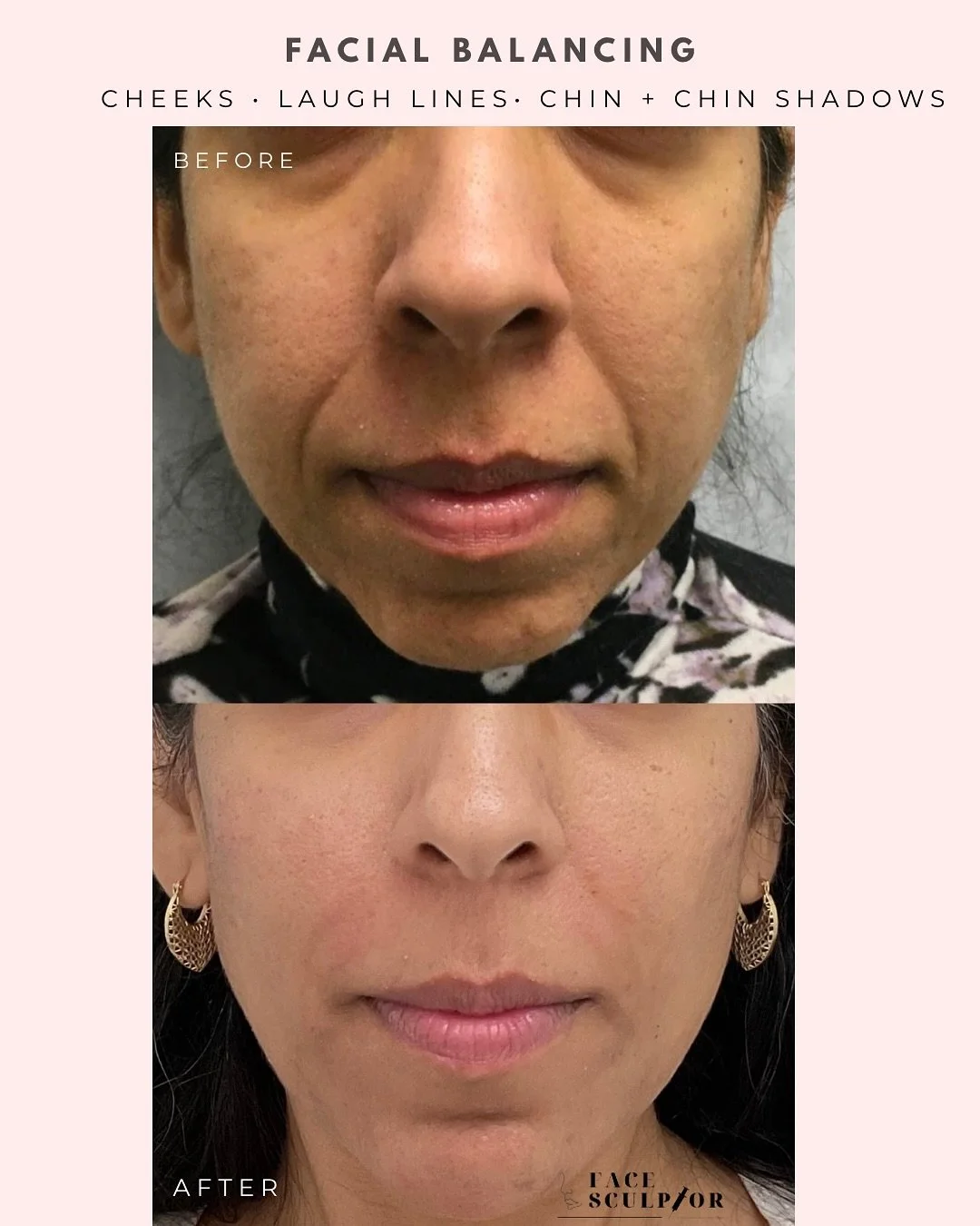 Facial balancing is not about changing your features &mdash; it&rsquo;s about harmonizing them. 💉
Using precise dermal filler placement, we enhance proportions, restore balance, and bring natural symmetry to the face &mdash; without overfilling. ✨
E