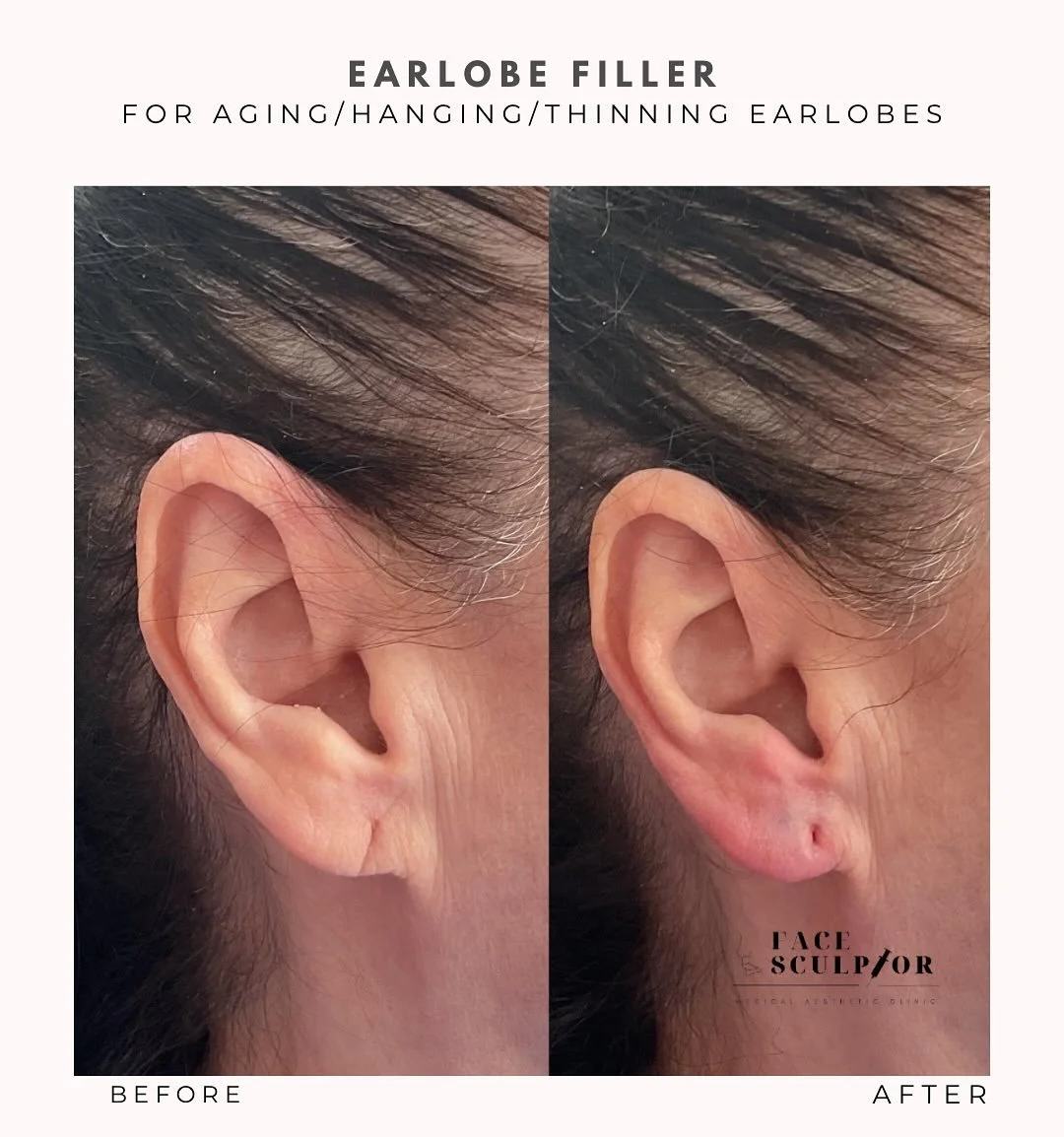 As we age, our earlobes naturally become thinner, longer, and less supported. Years of wearing heavy earrings, sun exposure, and collagen loss can make the earlobes look flat, wrinkled, or stretched, causing them to hang or look saggy. 👂🏾 

Earlobe