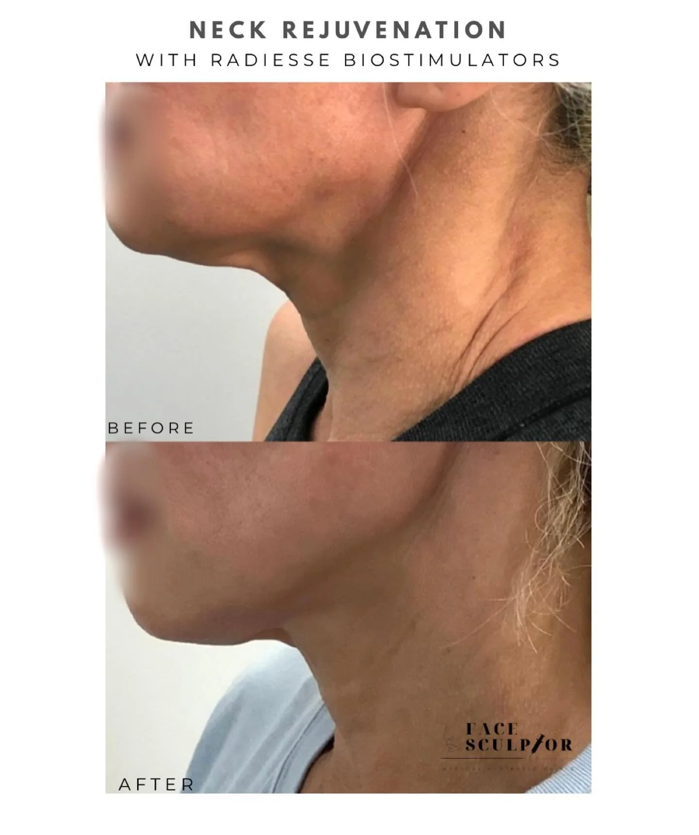 Neck lines softened. Skin tightened. Collagen boosted.
This is the magic of Radiesse Neck Rejuvenation. ✨

💉 Treatment performed by Nurse Chiara.

*Photos taken at 3 months apart. 

#NeckLines #TechNeckTreatment #RadiesseResults #CollagenStimulator 