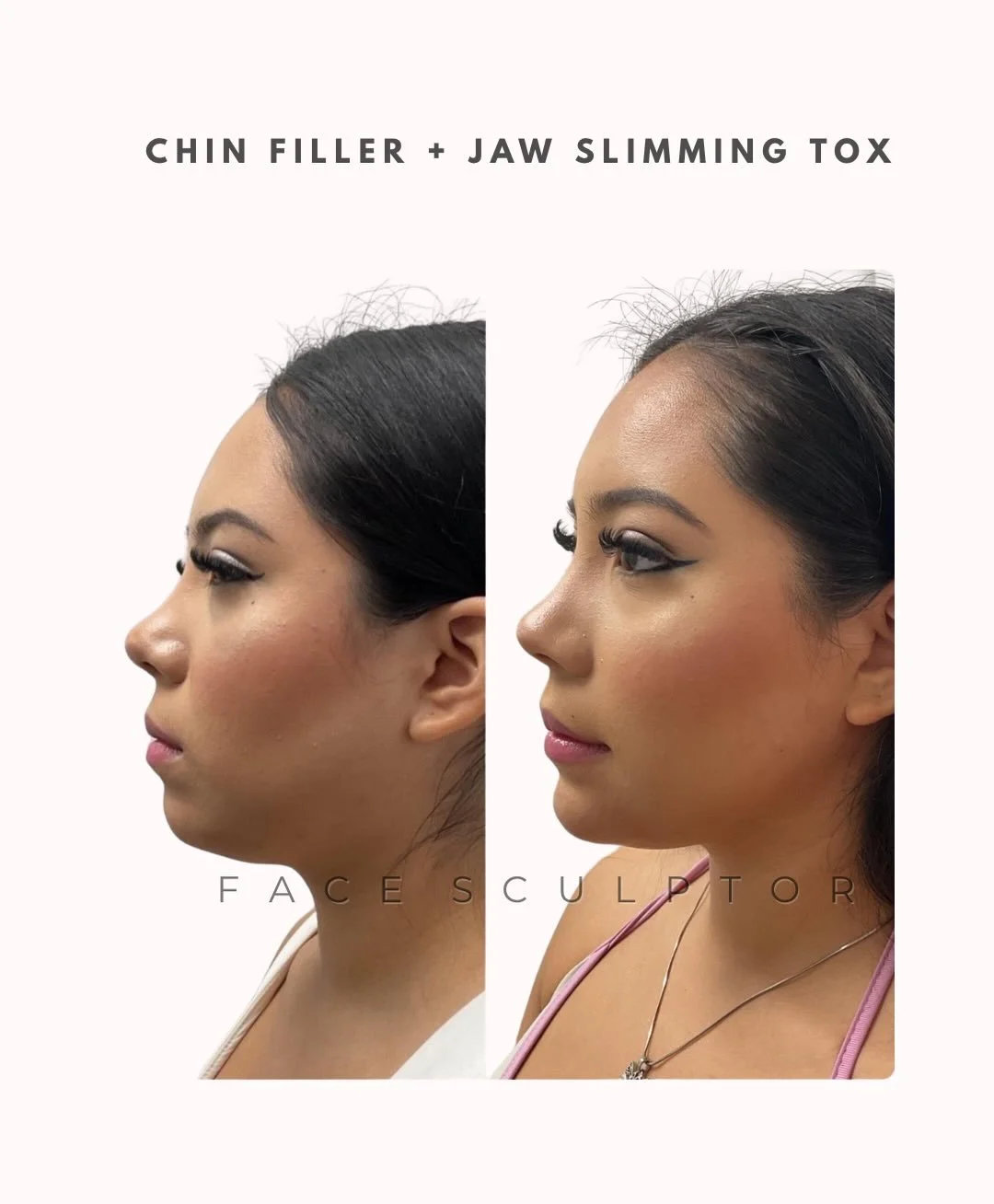 Chin filler paired with masseter Botox to soften the jawline, enhance projection, and improve overall facial balance ✨ Small changes, big impact. 

Results are individualized and assessed in consultation.

📍 Face Sculptor Medical Aesthetic Clinic
30
