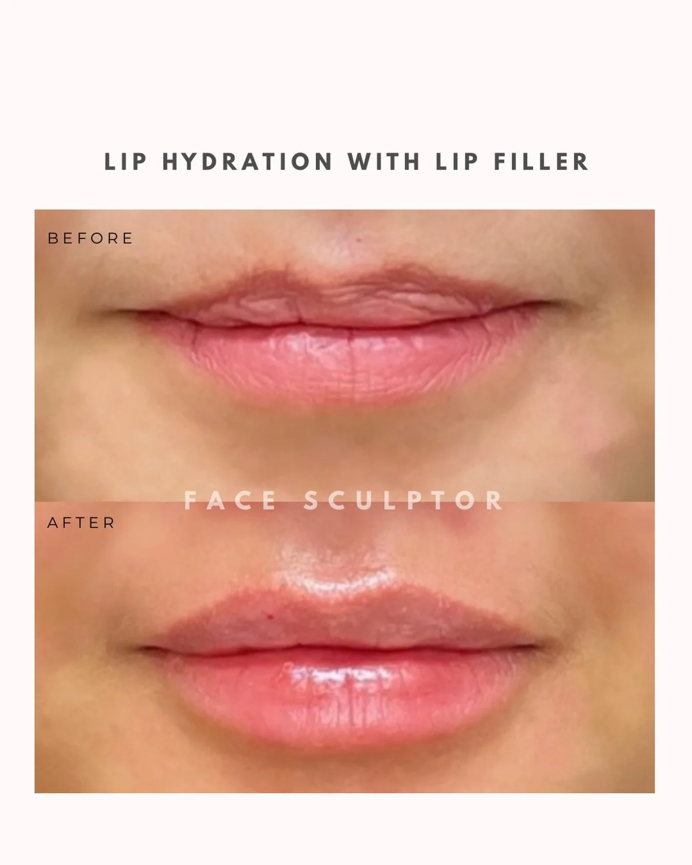 As we age, lips lose volume and structural support, which can make them appear thinner or less defined.

Lip filler is one option to help restore that lost volume and enhance natural shape. 💉✨