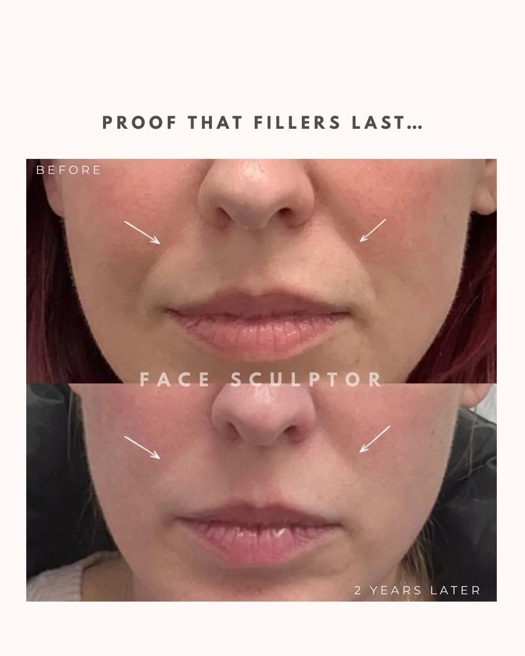 Fillers can last a long time.

This patient received dermal fillers on the smile lines 2 years ago, and the product is still present today.

Longevity of fillers depends on several factors:
&bull; Proper injection technique
&bull; Correct placement b