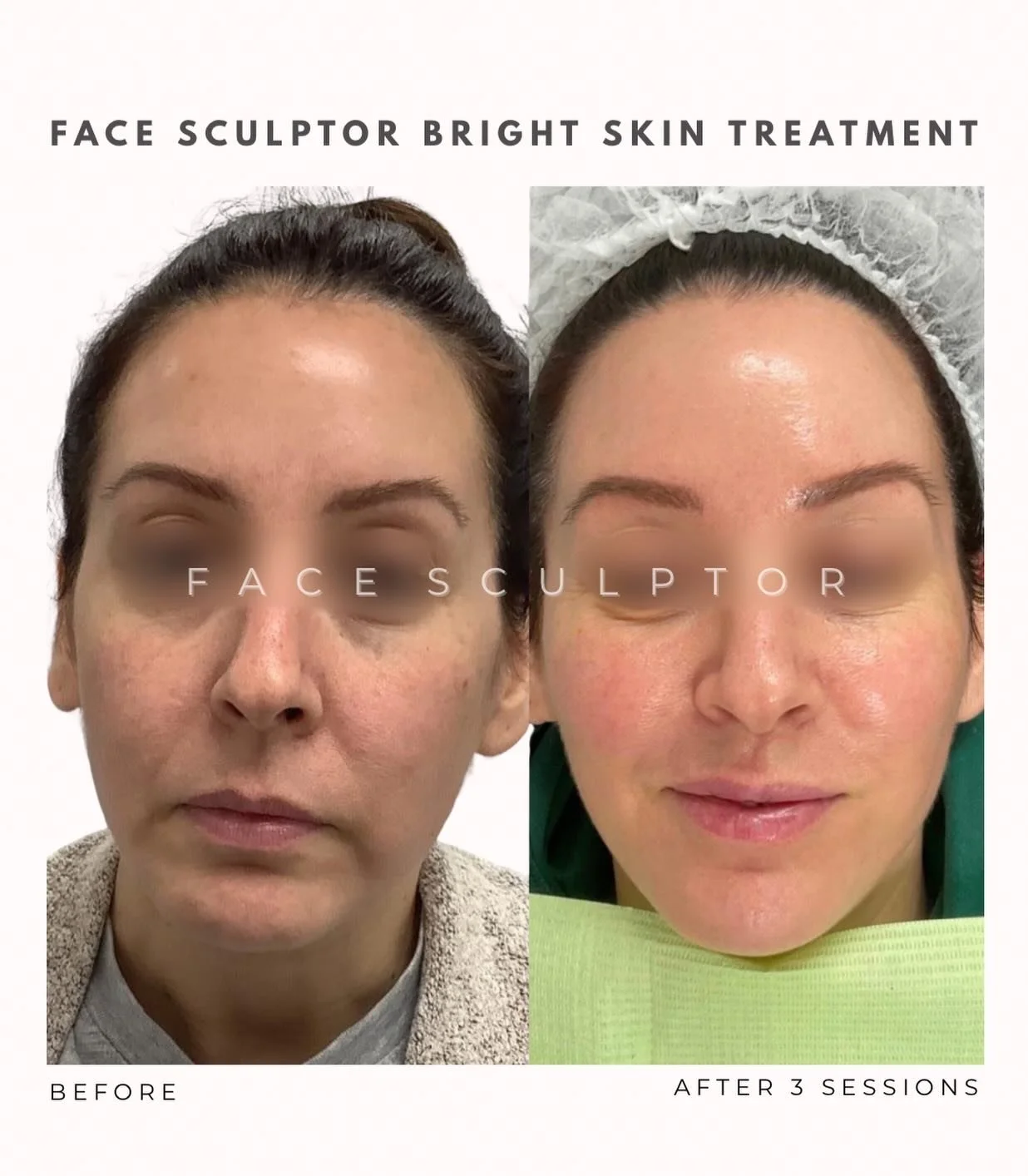 Your skin, just healthier, smoother, brighter. Glowing skin is always in. 

#SkinTransformation #microneedling #FaceSculptorBrightskin