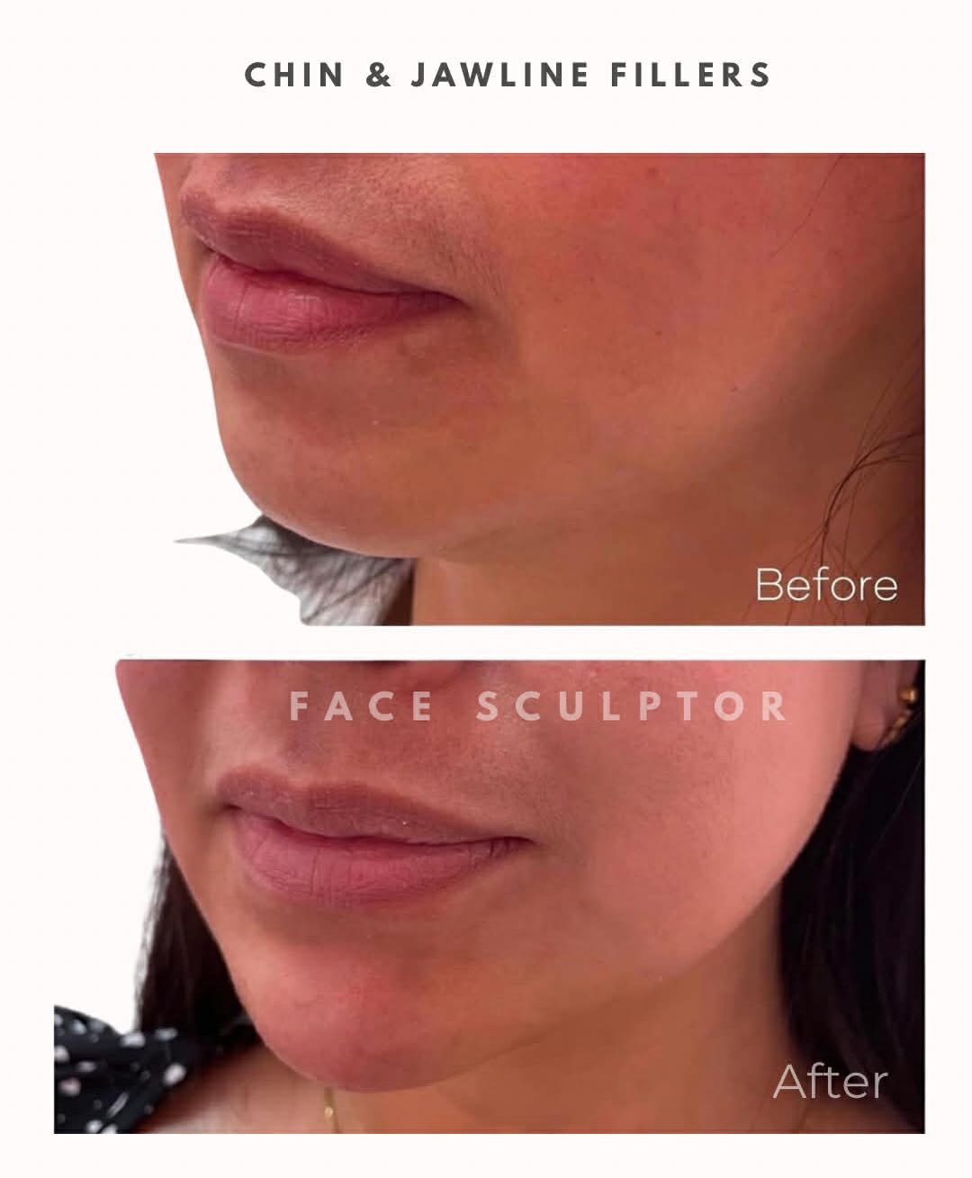 A little projection.
A little definition.
A whole lot of balance. 

#chinfiller #jawlinefiller #facialbalancing