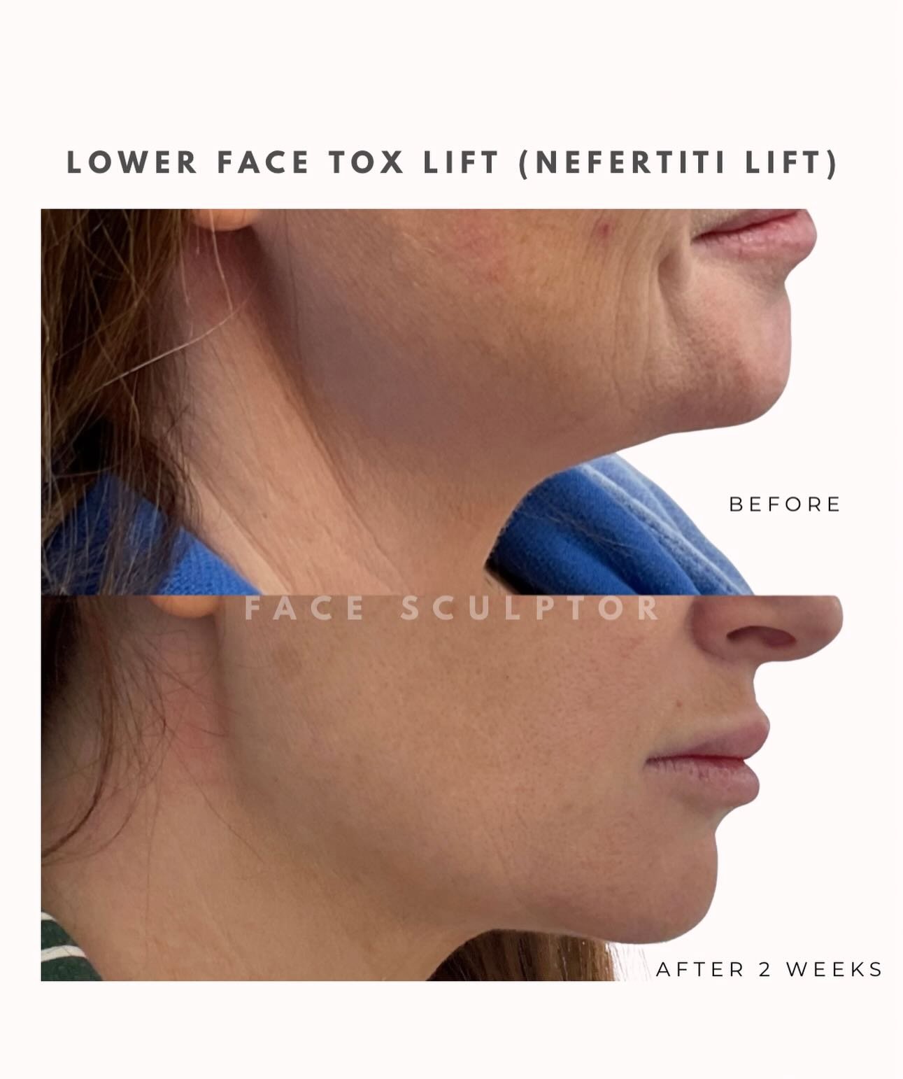 Strategic placement of neuromodulator (Botox) along the jawline and upper neck relaxes the downward-pulling muscles, allowing the face to lift subtly and naturally.

Proper placement, depth, and dosage make all the difference.

Book your consultation
