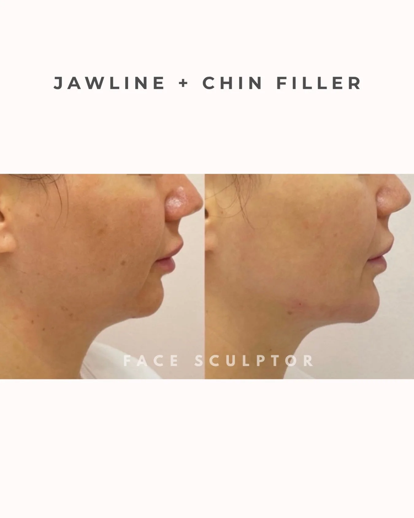 Sculpted jawline + defined chin = balanced, refined profile ✨