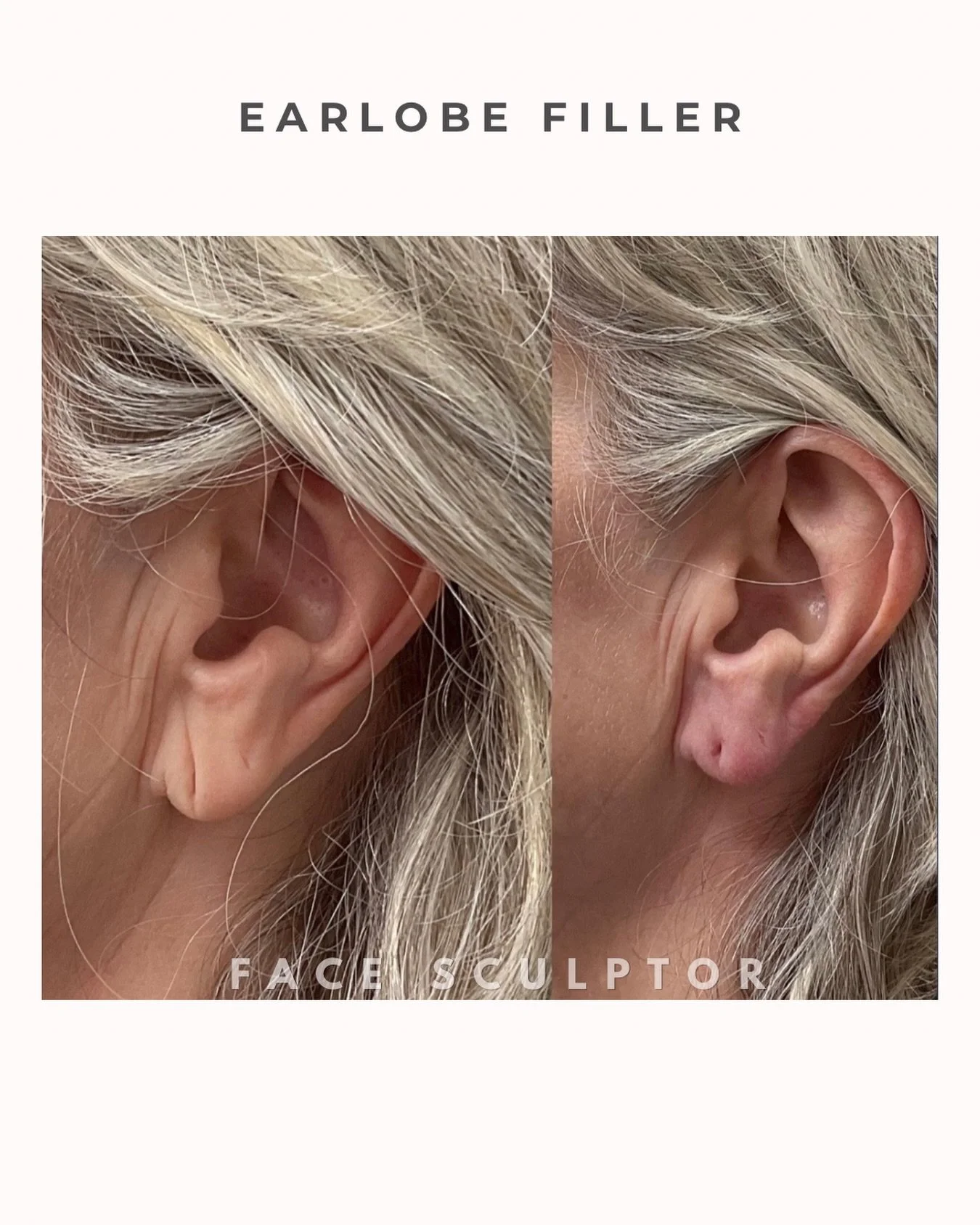 Ears lose volume as we age&mdash;so earrings start to hang instead of sitting nicely.

Ears look fuller, more youthful, and earrings sit beautifully again with a touch of filler.

Subtle tweak, big difference ✨

#EarlobeFiller #NaturalResults #Aesthe
