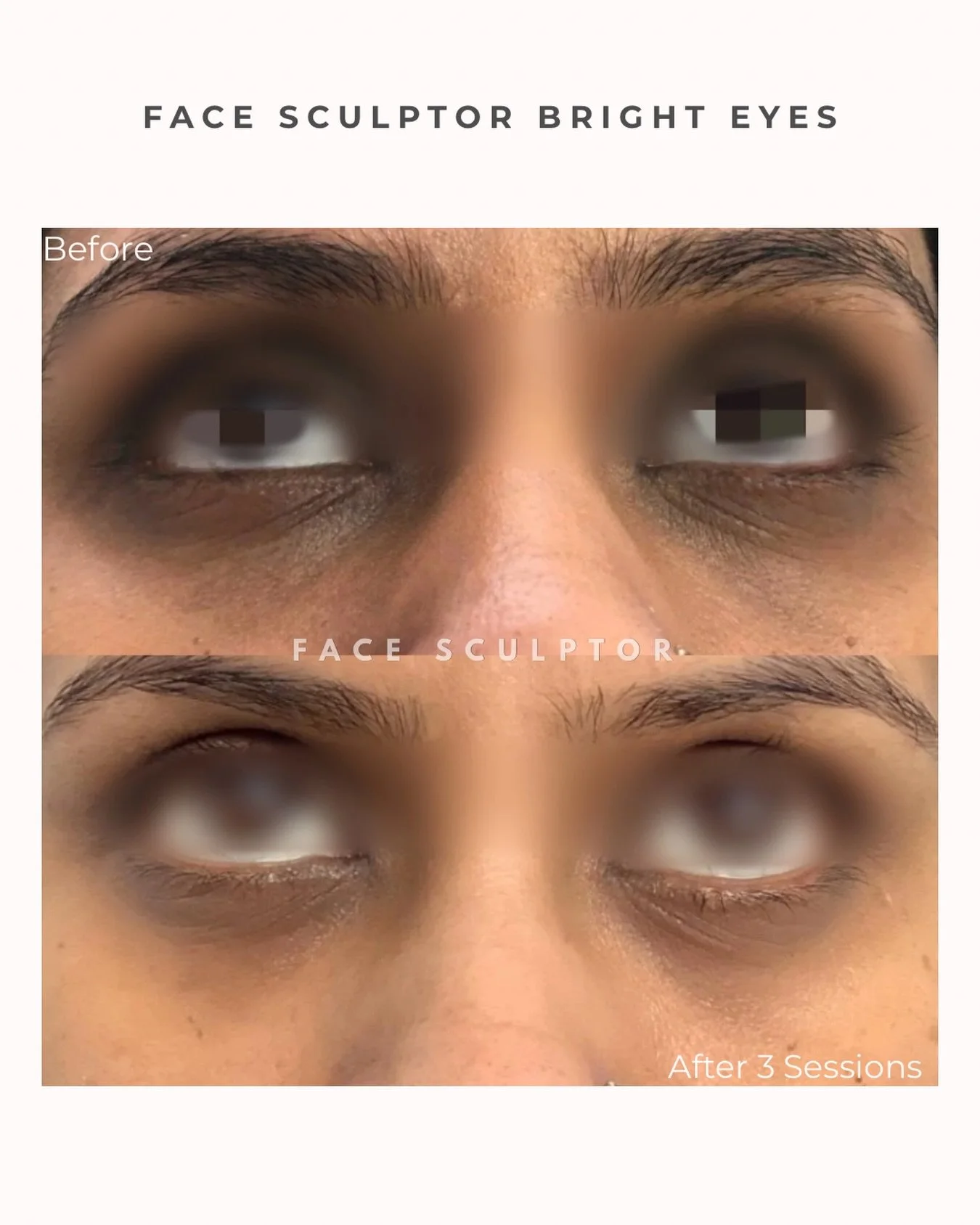 Bright Eyes | After 3 Sessions

Progressive improvement in under-eye brightness, hydration, and overall skin quality.
This treatment targets pigmentation and fine texture through superficial skin rejuvenation.

Results are gradual and cumulative, wit