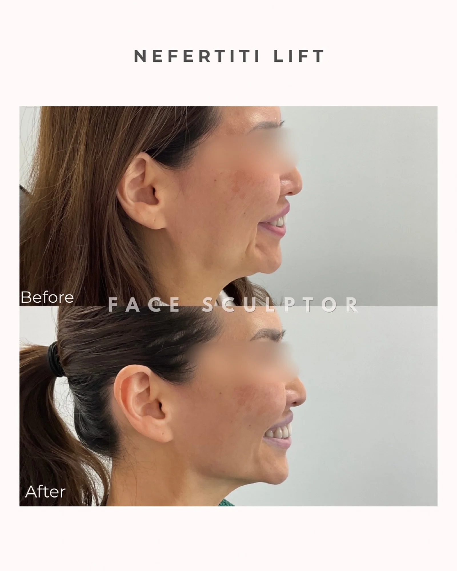 Defined jawline, softer neck lines, subtle lift.

The Nefertiti Lift uses Botox to relax the downward pull of the neck muscles, helping create a smoother, more lifted appearance along the jawline and neck.

Natural results, refreshed look &mdash; alw