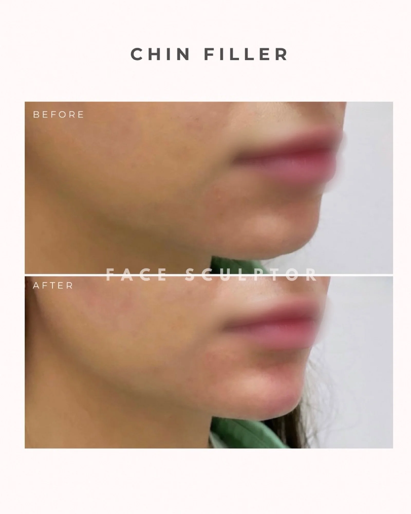 Subtle structure. Balanced profile. Natural-looking definition. ✨

Chin filler is not about making the chin &ldquo;bigger&rdquo; &mdash; it&rsquo;s about creating harmony and balance with the rest of the face. Depending on one&rsquo;s anatomy, this t