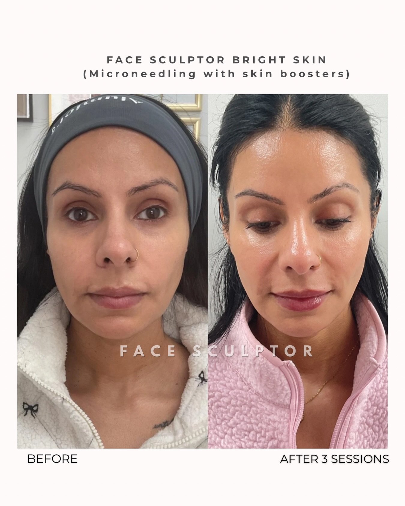 Microneedling + Skin Booster ✨

One of my favourite treatments for improving overall skin quality.

This treatment creates controlled micro-channels in the skin while infusing a skin booster packed with hyaluronic acid, vitamins, antioxidants, and pe