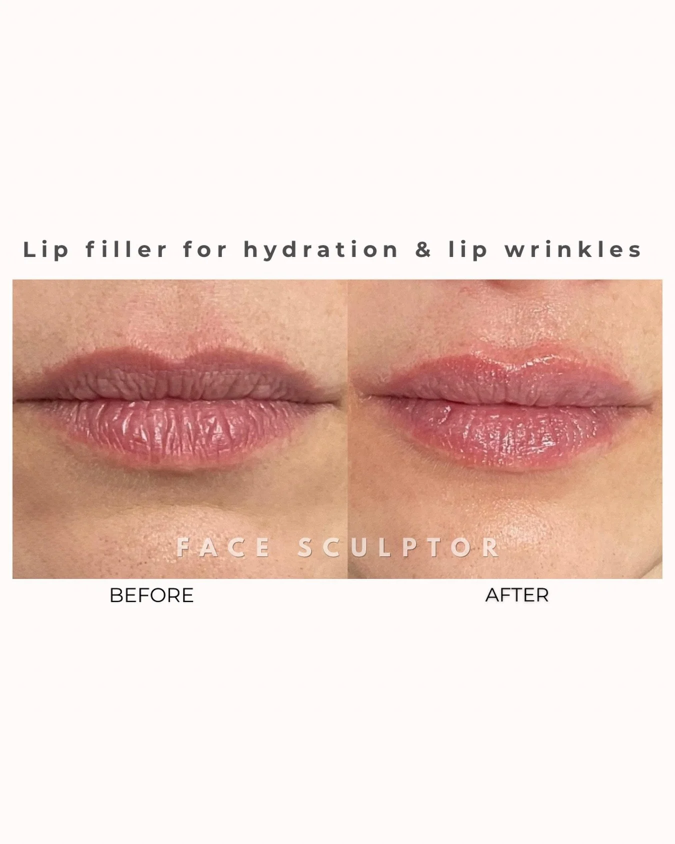 Hydration. Definition. Smoothness. 💋

Lip filler can do more than add volume&mdash;it helps restore hydration and soften lip wrinkles for a refreshed, natural look.

Subtle enhancements, beautiful results ✨