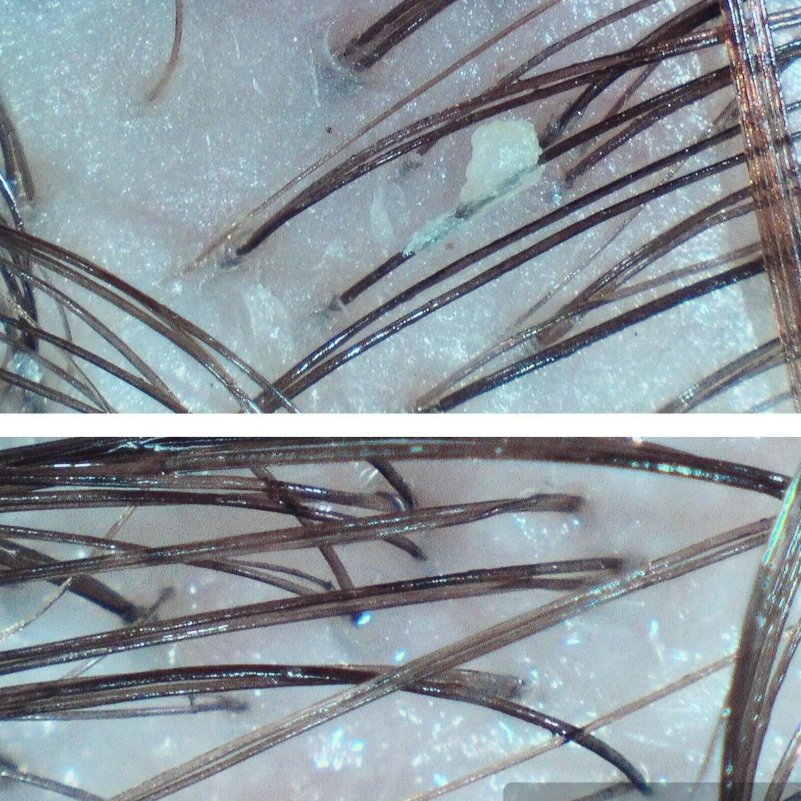 before and after dandruff scalp pictures treatement
