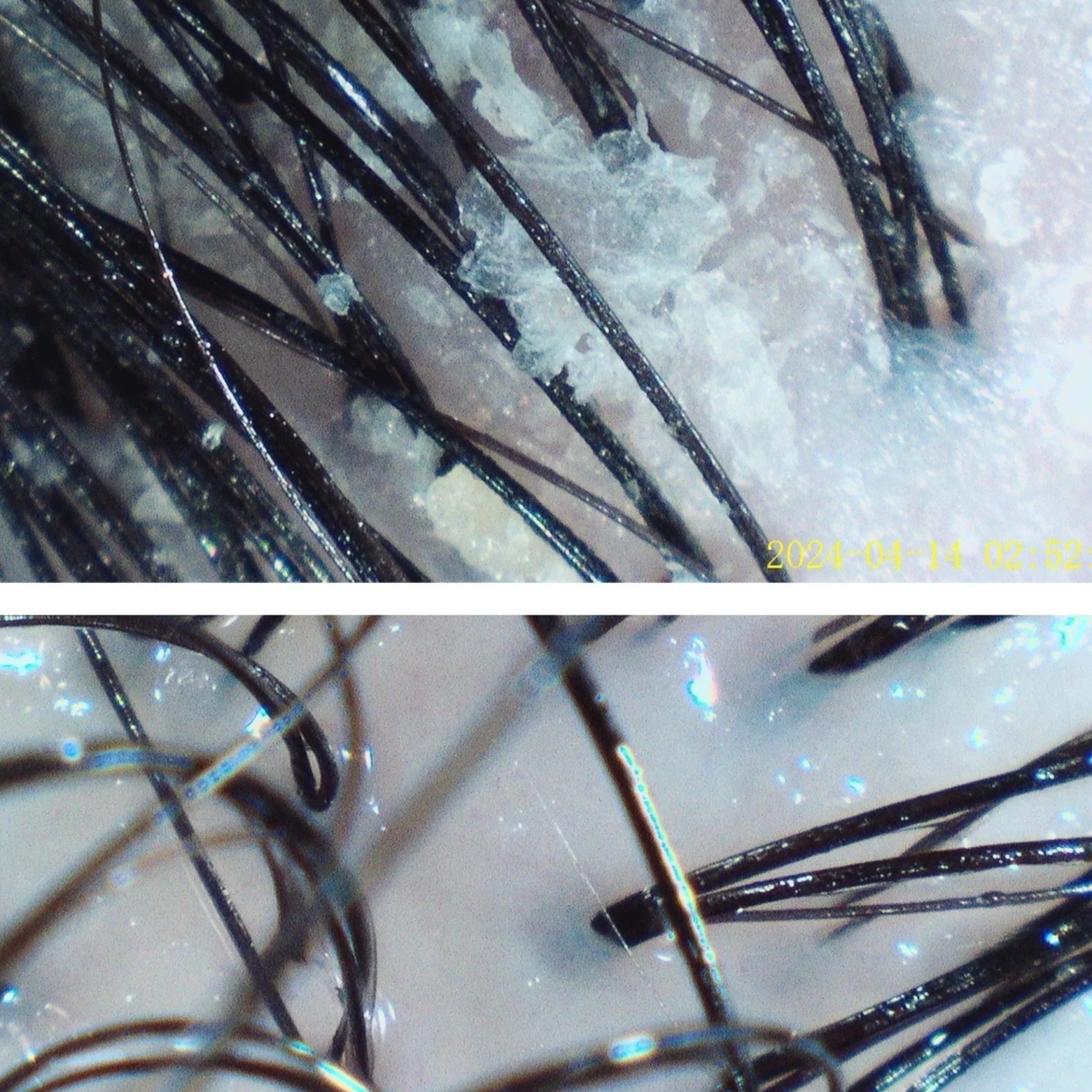 before and after dandruff scalp pictures treatement