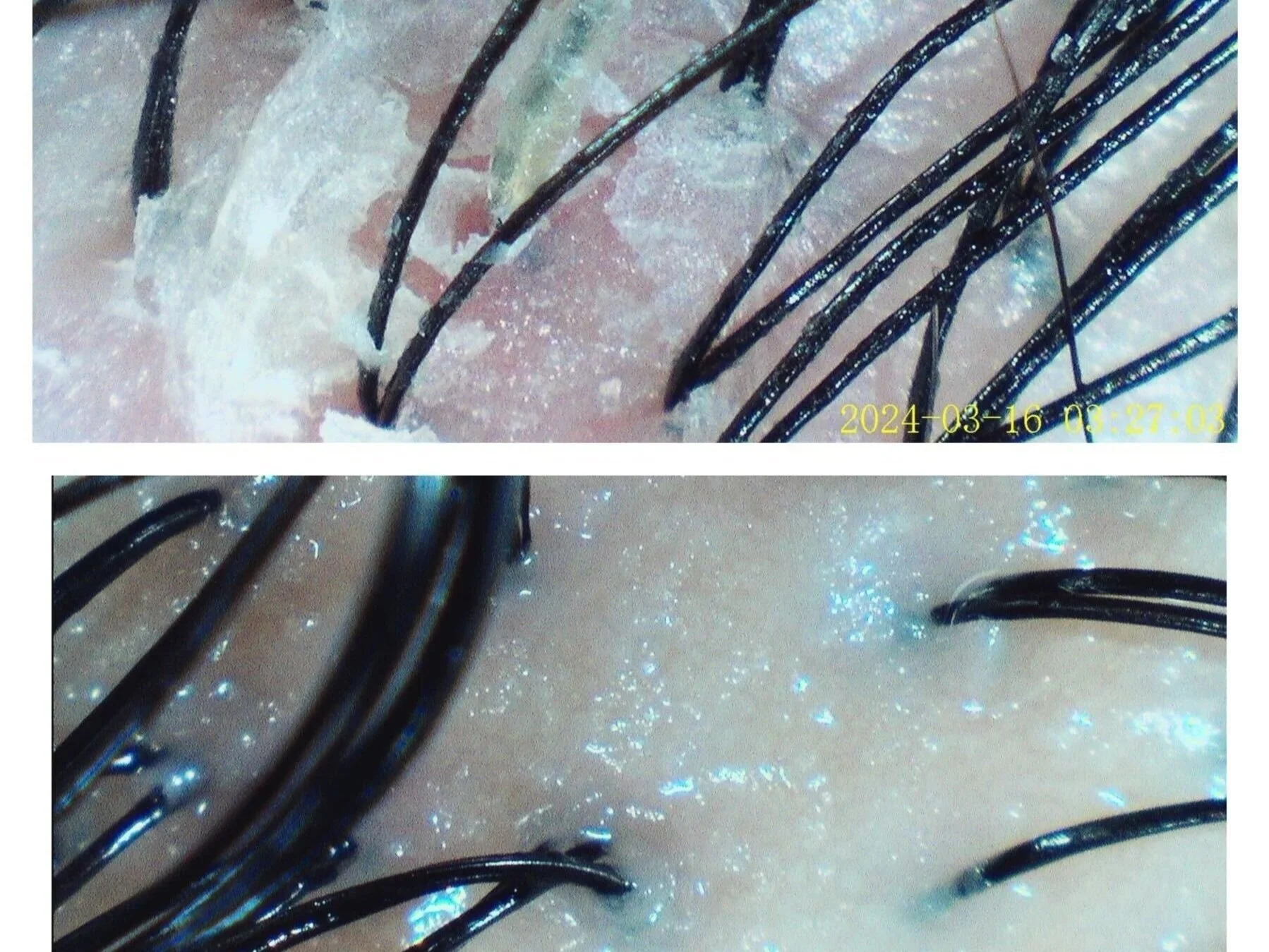 before and after dandruff scalp pictures treatement
