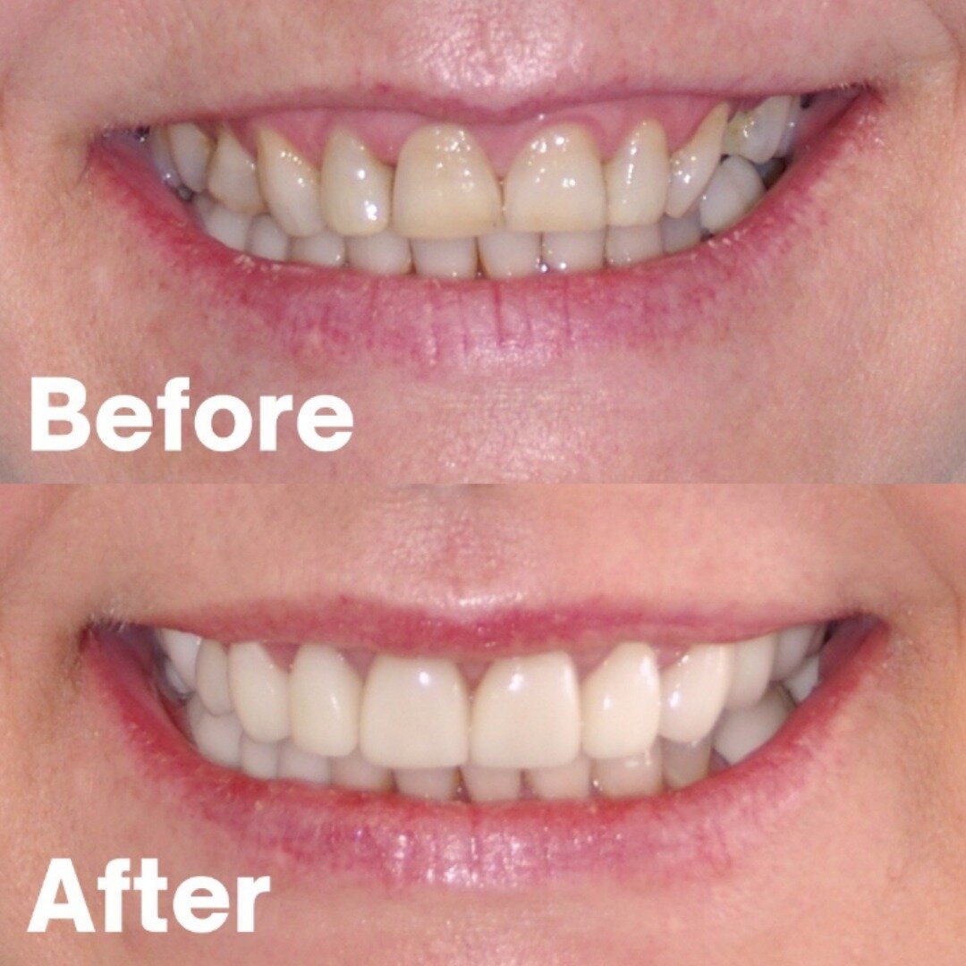 Improving the appearance of your smile doesn&rsquo;t have to be hard! A laser smile lift and ceramic crowns have elevated this clients smile to the next level. 😄
.
.
.
.
.
.
.

#Dental88 #FamilyDentist #DentalPracticeWA #CosmeticDentists #Preventati