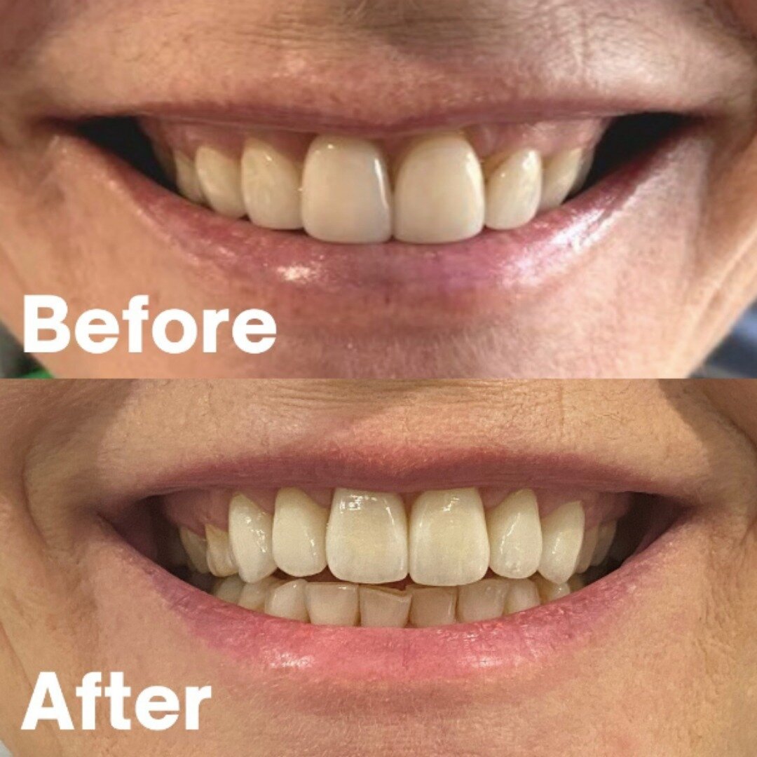 It&rsquo;s the little things 🔬&hellip; updated crowns for this patient&rsquo;s six front teeth have given her a whole new smile 😃 If you want to improve your smile, get in touch with us today for an initial consult. 📞Call us on 08 9756 8000.

If y