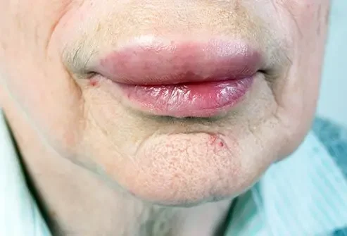 9/9/25 - Angioedema