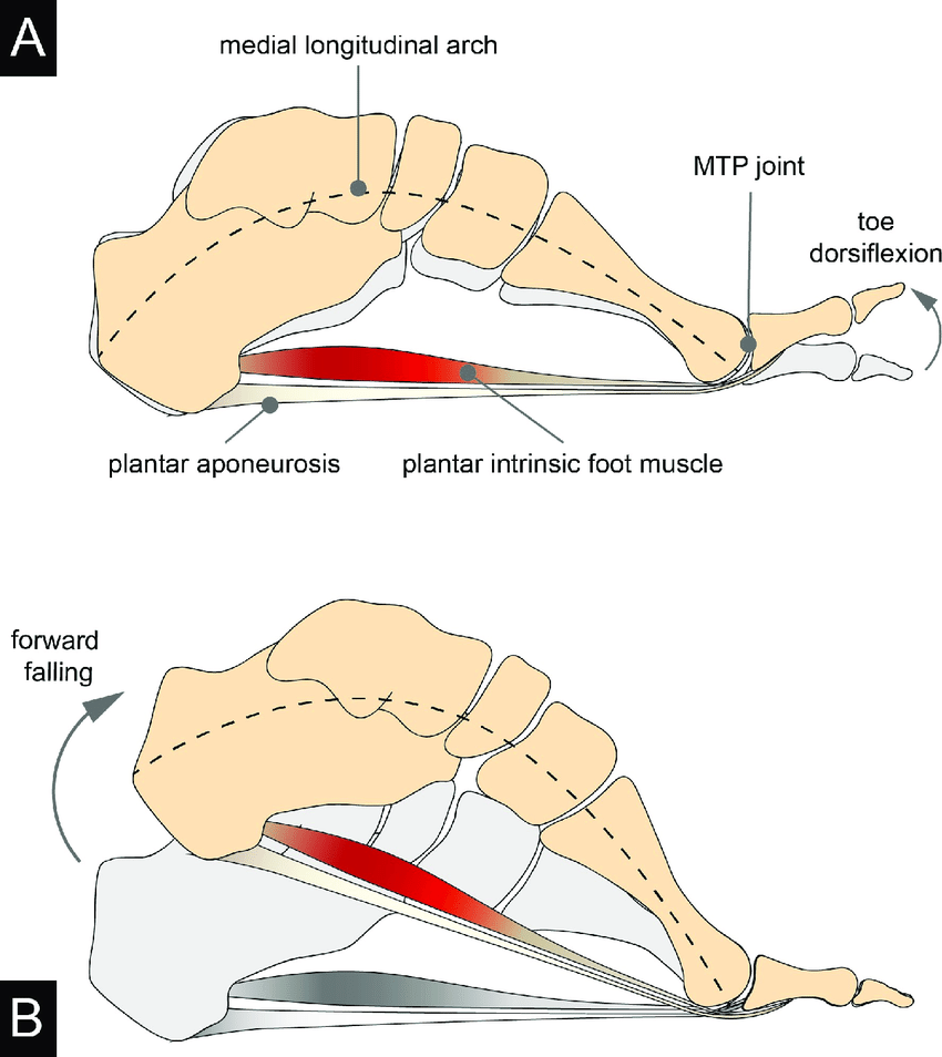 Plantarfasciitis now known as plantarfasciopathy — Agape Physiotherapy