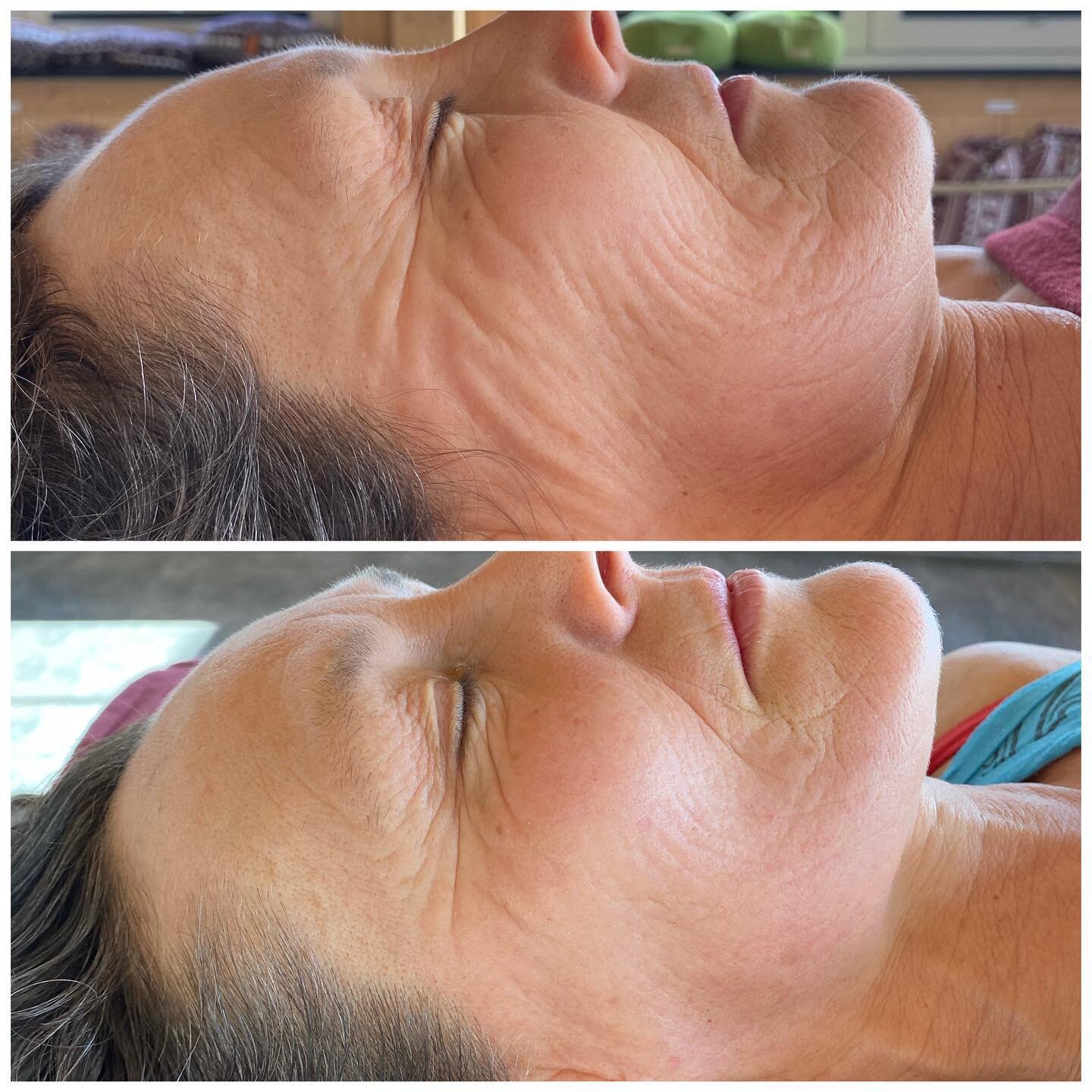 Another amazing result after #facialsculpting This client was over the moon happy with her results. Go to Bio in link to schedule your appointment.